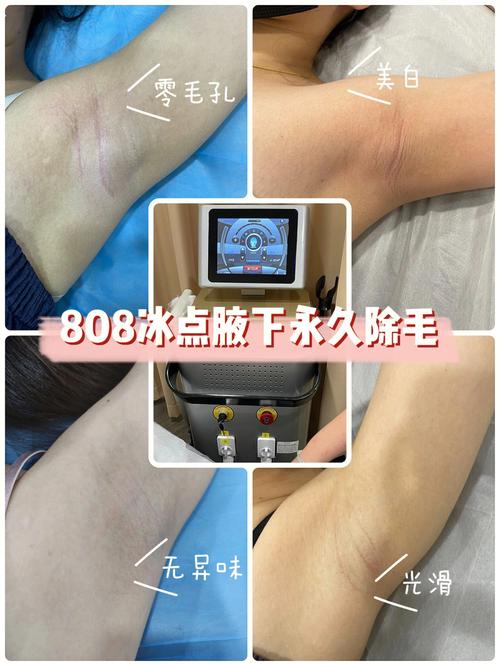 腋下冰点该怎么私处激光(激光腋下毛发冰点美白)