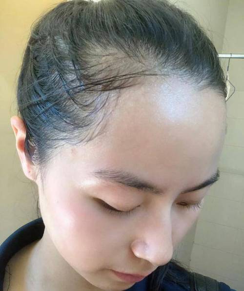 发际效果女生(发际色素头发头皮效果)