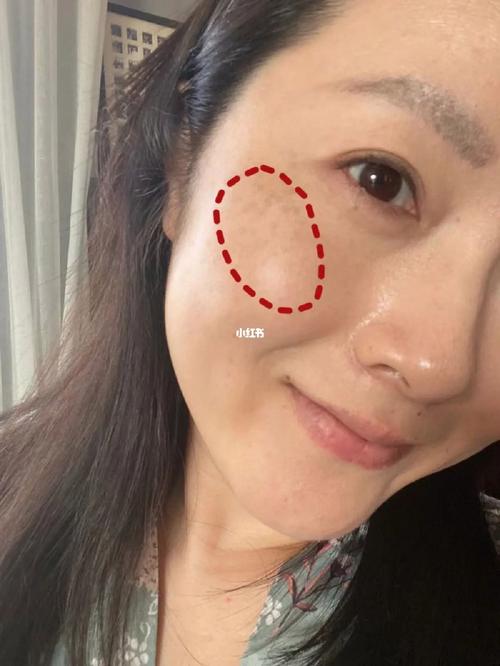 黄斑成了黑斑都得戴口罩(黑斑黄斑成了王女士祛斑)