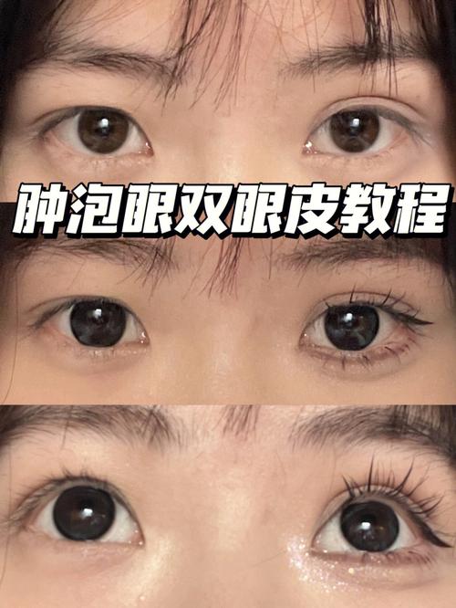 也能功课漂亮时间肿泡眼(双眼皮脂肪组织也能漂亮)