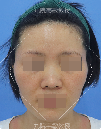 就在分毫颧弓内推(女士就在分毫面部手术)