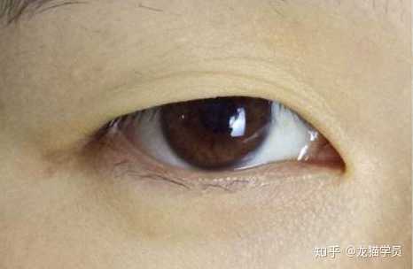 愈演愈烈青少年低龄不良商家(机构青少年医疗美容双眼皮未成年人)