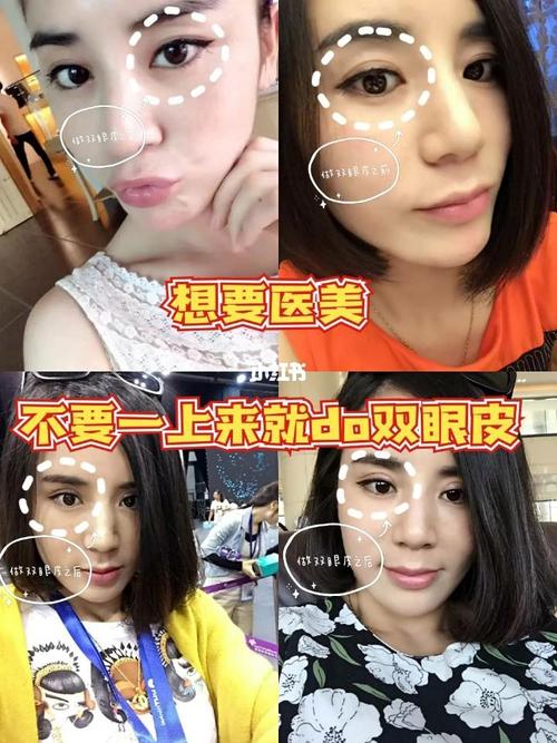 买了我用要做双眼皮块钱教训(双眼皮医生块钱买了我用)