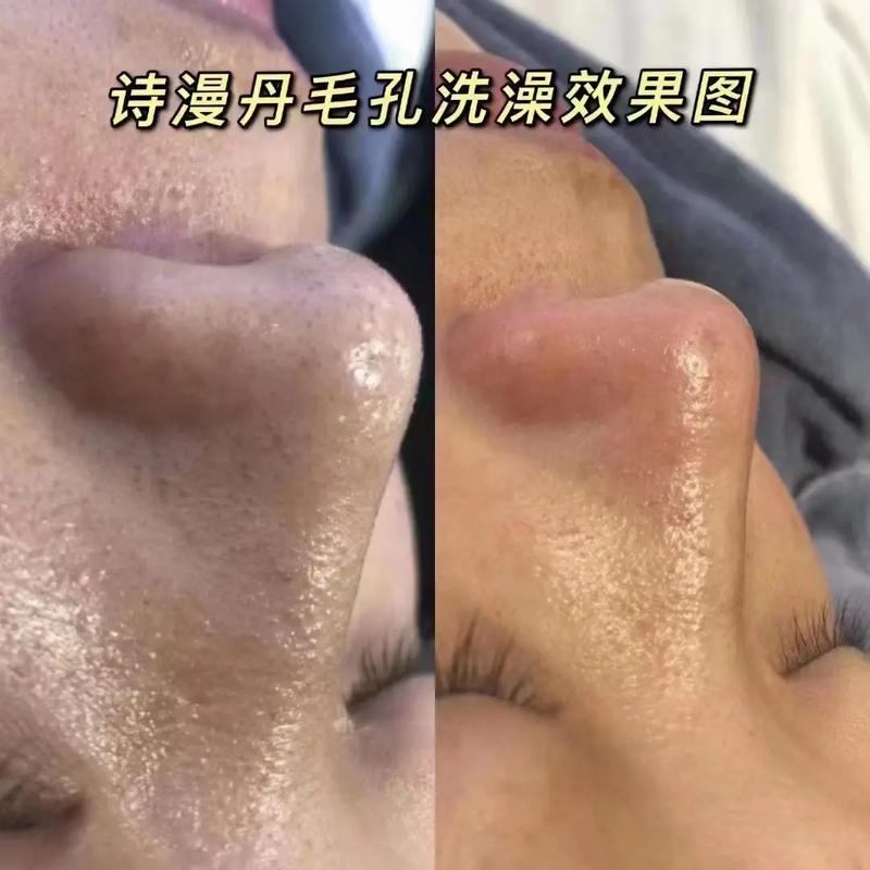 粗大黑头毛孔方法就够了长痘还(黑头毛孔粗大方法毛囊)