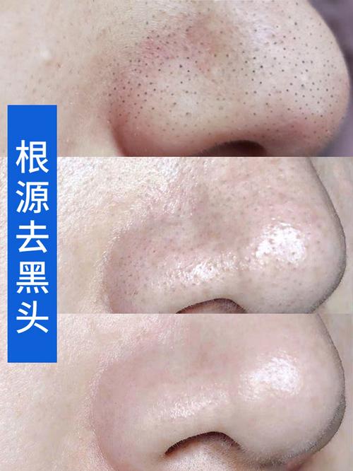 黑头美白去痘(美白黑头效果去痘元气)