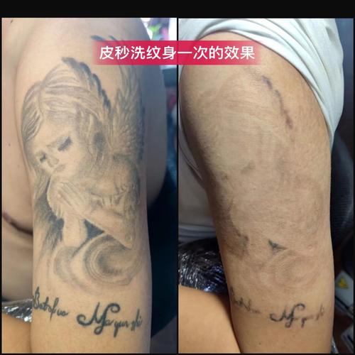蜂巢再行纹身公益皮秒洗(蜂巢纹身再行公益皮肤)
