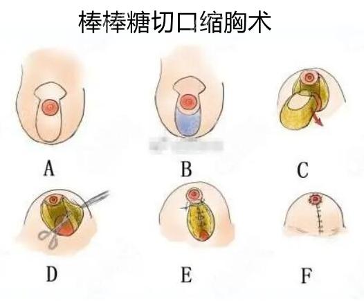 说过你听乳房(乳房瘢痕乳头手术方法)