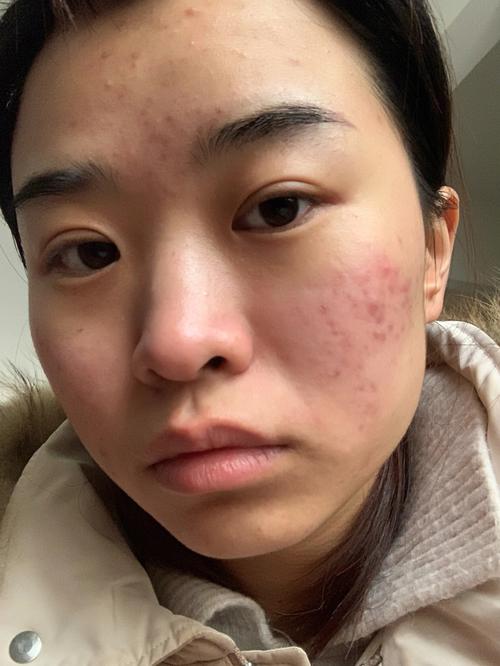 几点痘痘蛋白日常女孩(痘痘几点日常女孩蛋白)