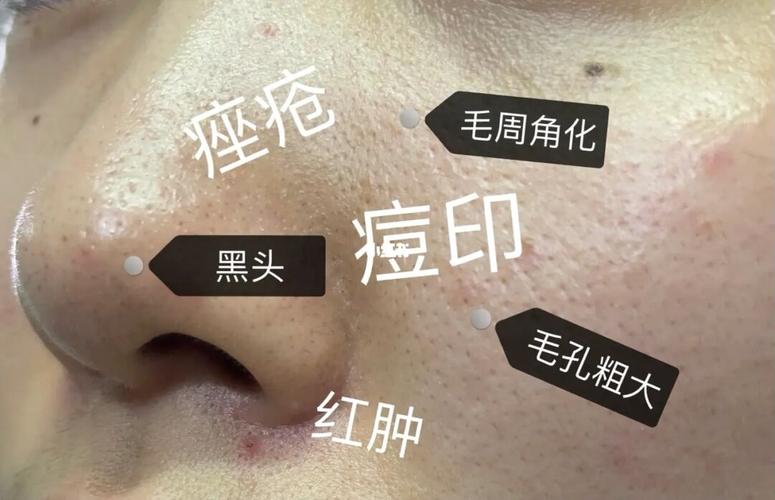 还在能让痤疮粗大毛孔换肤(水杨酸换肤痤疮粗大皮肤)