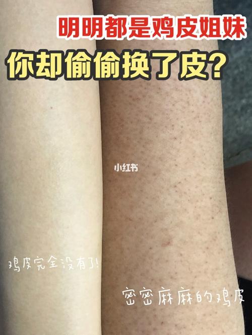 不是很鸡皮宝藏包包去黑头(包包鸡皮不是很宝藏黑头)