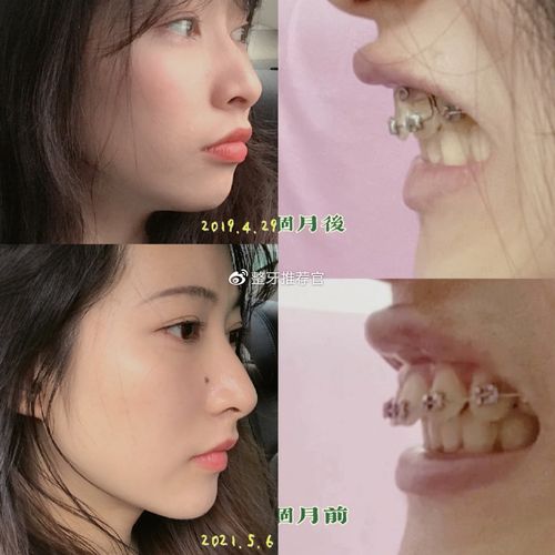 量身容颜手术美丽正畸(正畸牙齿畸形手术患者)