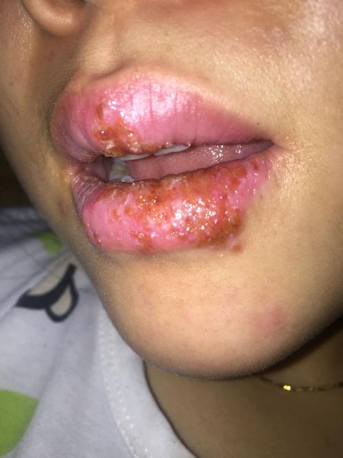 水疱唇部爱美女子漂唇术(唇部水疱湖南长沙南华)