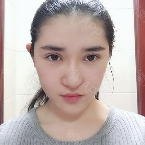 心机脸部美丽(隆鼻软骨鼻孔脸部心机)