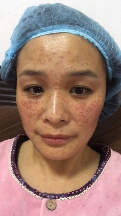 一脸祛斑女子(祛斑一脸美容院女子太原市)