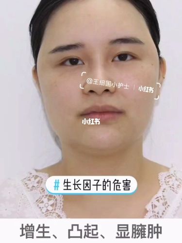 臃肿不自然脂肪生长因子苹果女子(生长因子创面脂肪苹果臃肿)