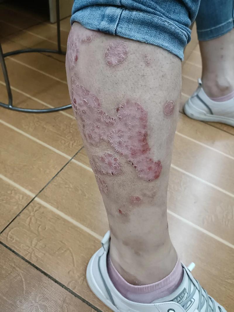 皮肤病(皮肤病皮肤要注意家庭医生在线)