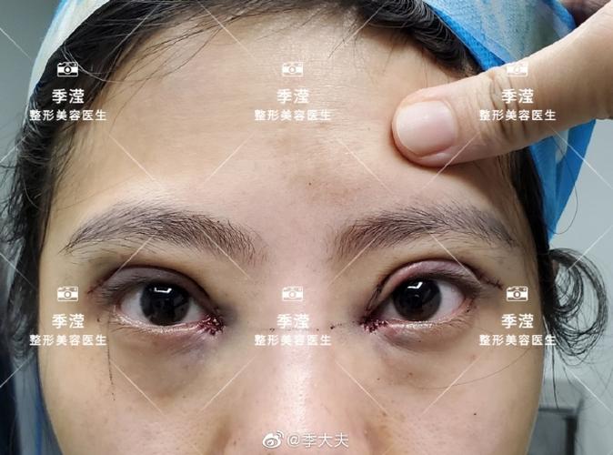 双眼皮打过适合做手术医生说肉毒素(双眼皮手术肉毒素去皮打过)