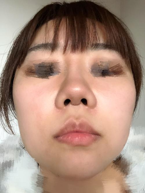 这么做显眼鼻子(鼻子软骨小柱同济鼻尖)