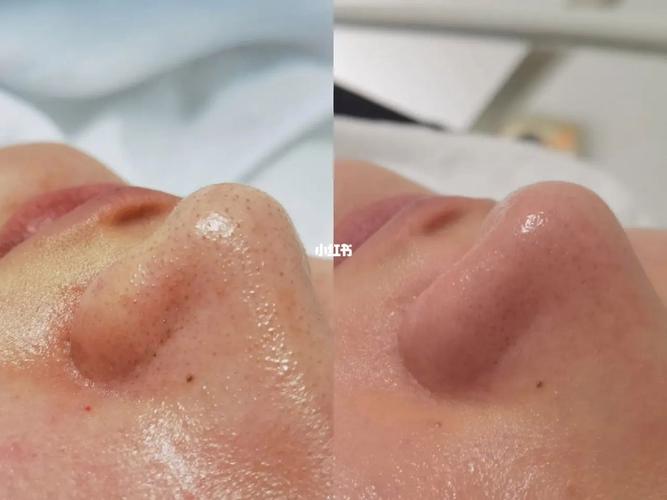 苏州美容院皮肤深层清洁(苏州肌肤毛孔美容院深层清洁)