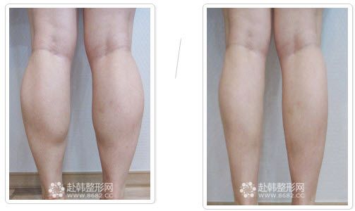 日本腿部小腿堪比抽脂瘦腿(腿部日本小腿瘦腿抽脂)