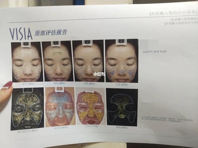 黄褐斑雀斑该如何项目(黄褐斑雀斑超声项目该如何)