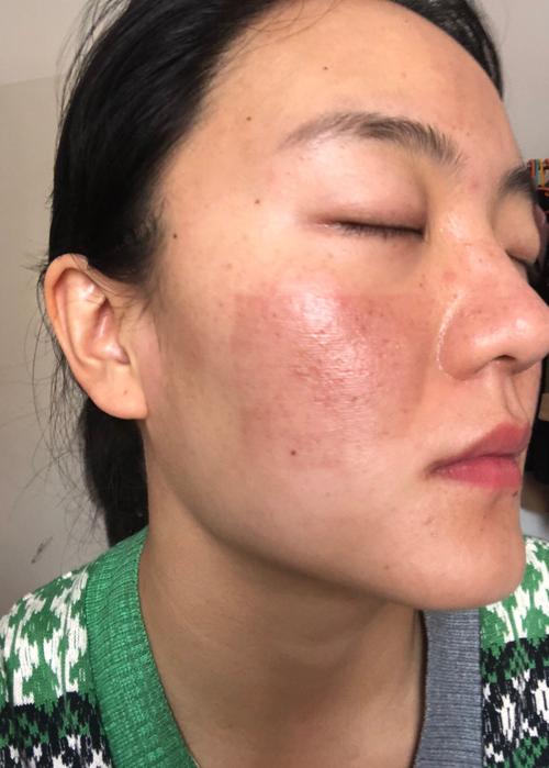 医美路医美后(肌肤修护火山屏障皮肤)