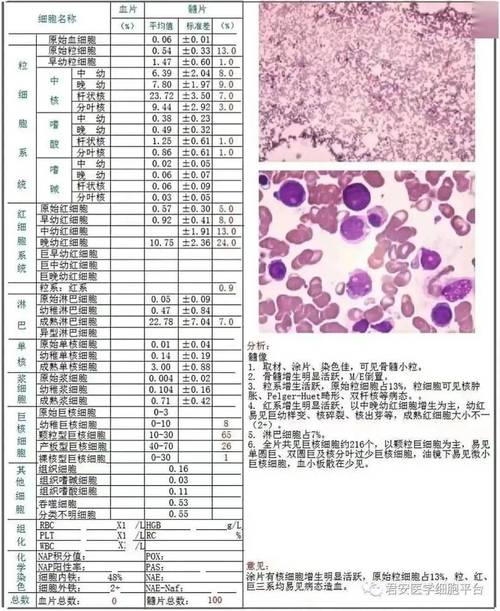 张敏MDS(患者骨髓细胞原始较低)