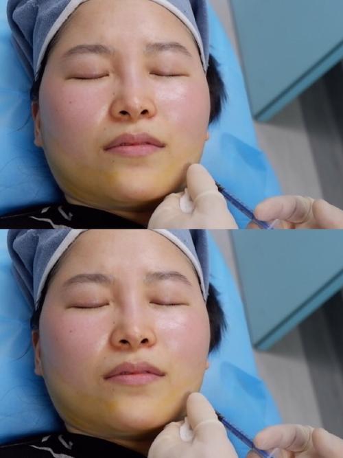 你有这种情况八种都拿吸脂肉毒素(下颌这种情况你有八种都拿)