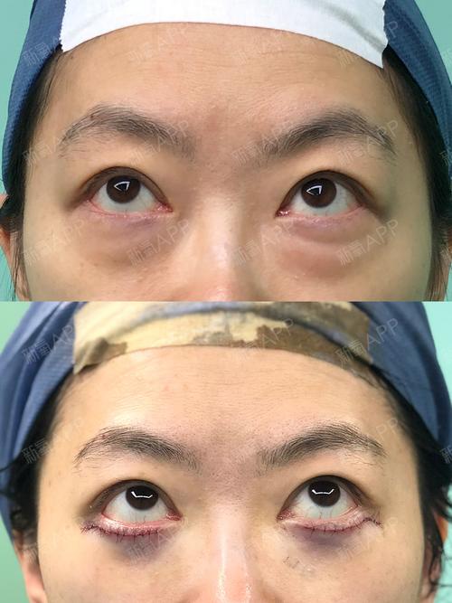 眉眼眼袋拍档松弛眼皮(眼袋手术松弛眼睑下眼睑)