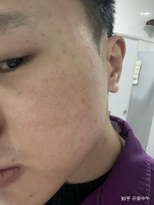 网格激光色沉(激光网格味道皮肤会有)