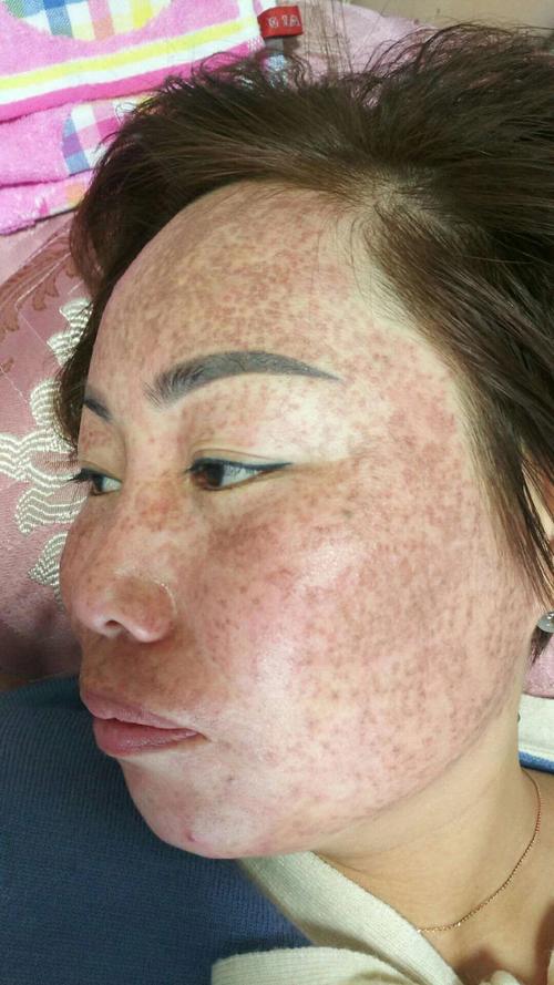 德州花了祛斑女子专家(女士齐鲁祛斑德州店家)