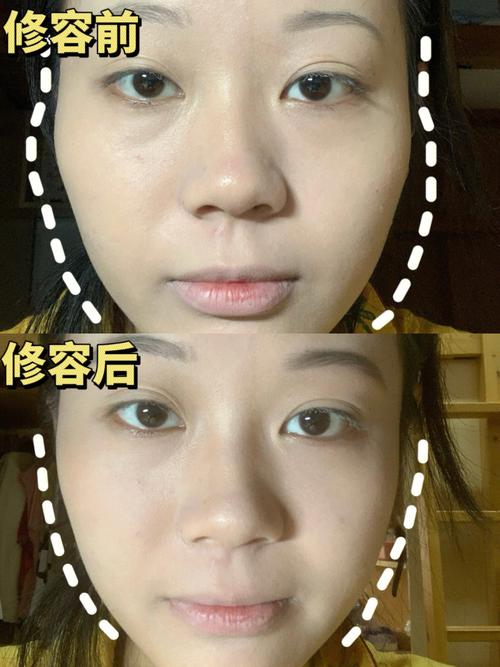 颧骨晚了后遗症僵硬还好吗后悔(颧骨晚了后遗症僵硬还好吗)