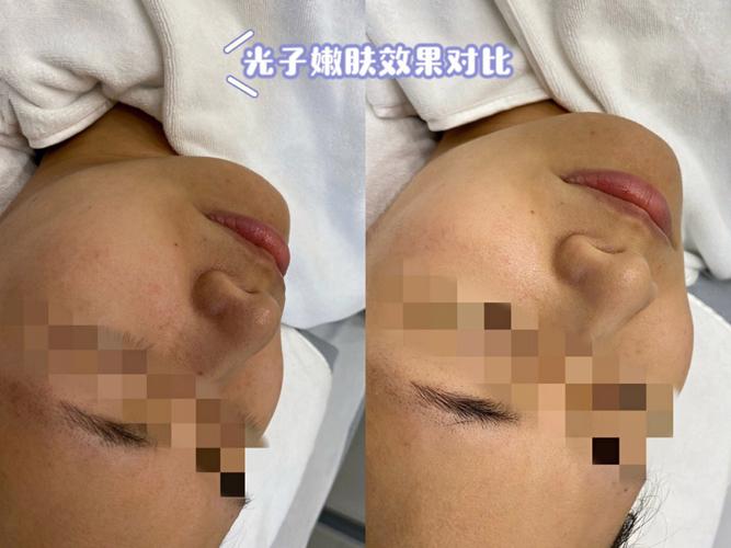 嫩肤光子有什么不同(嫩肤光子皮肤整形外科有什么不同)