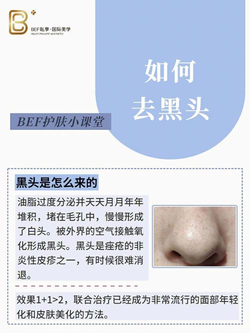 杭州黑头美容院天价去黑头(黑头美容院杭州天价去黑头)