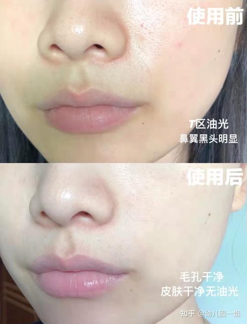 还得黑头简单方法(黑头毛孔面膜果酸油脂)