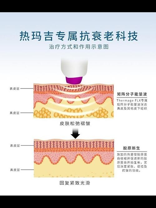 到底是什么很大年轻热玛吉(胶原蛋白皮肤胶原效果能量)