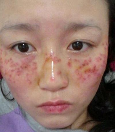 反黑后会过程中美肤现象颐佰嘉丨(皮肤反黑祛斑自己的后会)