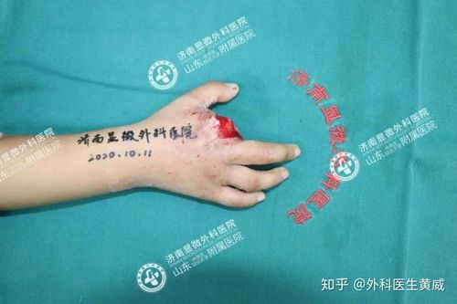 全形手指精准面纱我院神秘(手指全形精准我院技术)