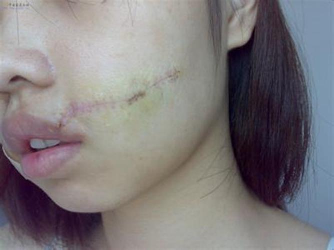 做医美前(医疗美容患者手术正规瘢痕)