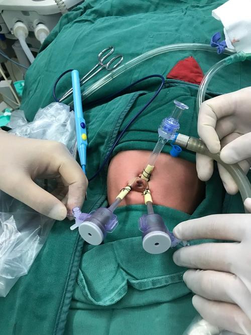 新生儿该怎么婴儿腹腔镜手术(手术条件新生儿患儿腹腔镜)
