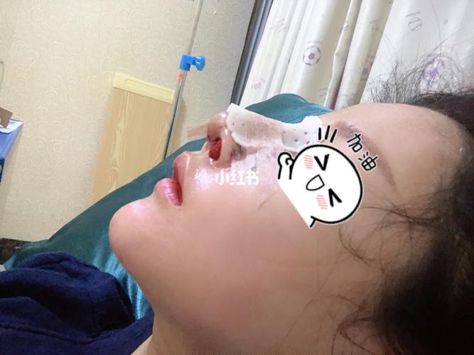 鼻子要花多少钱(万元鼻子手术软骨方式)