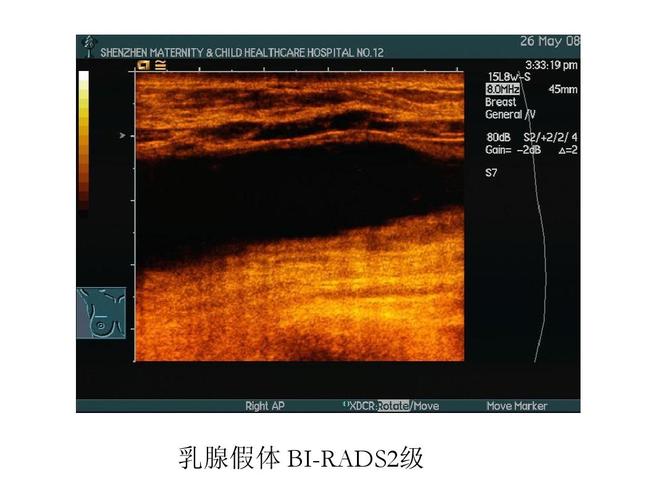 假体(假体乳腺癌手术凝胶超声)