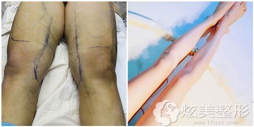 成都手术后大腿麻木抽脂手术(女士手术大腿医院抽脂)