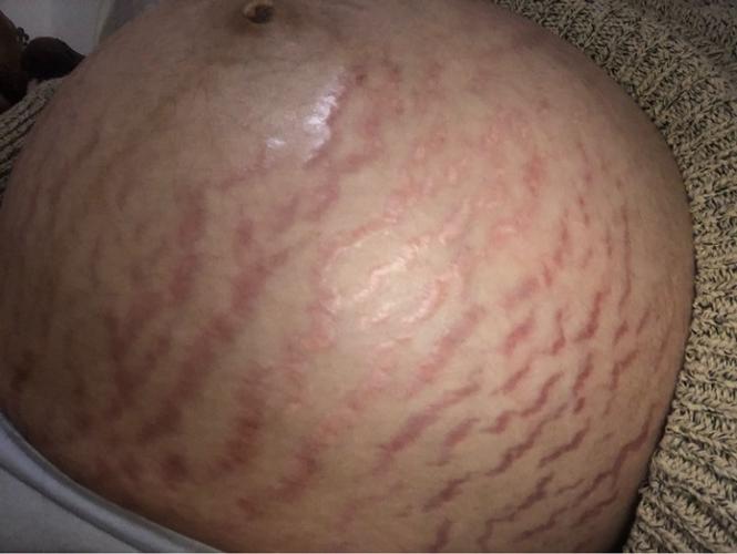 讲究要好妊娠纹孕早期(皮肤妊娠纹准妈妈腹部部位)
