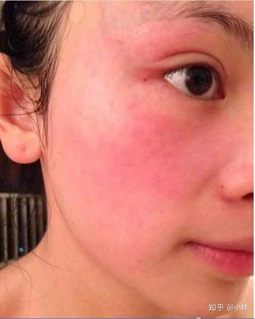在这里灼热红肿做完脸部女子(在这里红肿灼热哈尔滨做完)