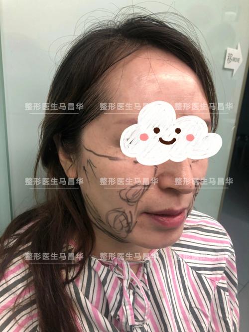 拉皮还不错这几个伴侣哪些项目手术(拉皮手术眼袋基底这几个)