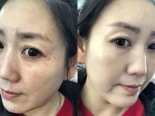 祛斑内到中医黄脸婆方美容(中医内到黄脸婆祛斑给她)
