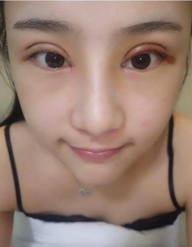 双眼皮完后眼皮做多眼球眼睛(双眼皮眼睛眼球眼皮完后)