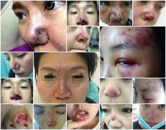 骨粉还需要谨慎医疗美容填充物(骨粉隆鼻填充物生长因子医疗美容)