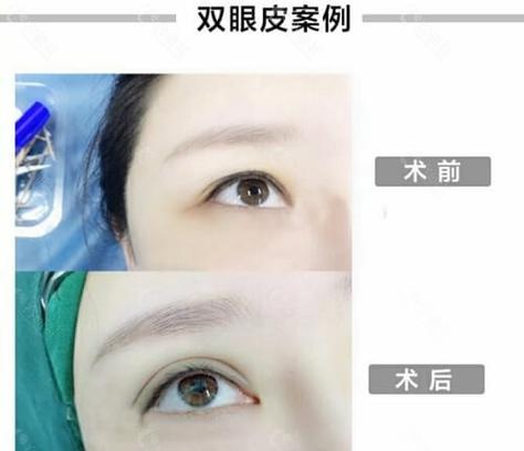 济南双眼皮几种海峡手术常见(双眼皮手术眼部济南海峡)